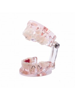 Dental Study Teeth Model Pathological Disease Demonstration Model EASYINSMILE 