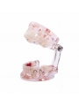 Dental Study Teeth Model Pathological Disease Demonstration Model EASYINSMILE 