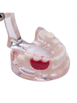 Dental Study Teeth Model Pathological Disease Demonstration Model EASYINSMILE