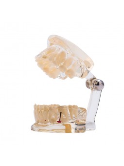 Dental Teeth Implant Pathological Model Teach Model Adult Size EASYINSMILE