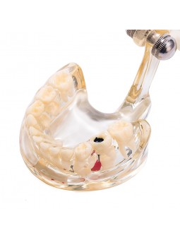 Dental Teeth Implant Pathological Model Teach Model Adult Size EASYINSMILE