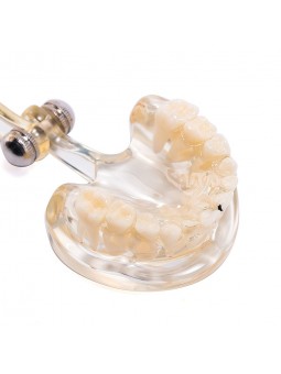 Dental Teeth Implant Pathological Model Teach Model Adult Size EASYINSMILE