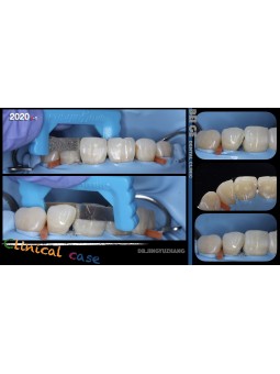 Dental Orthodontic Plus Strips Enamel Interproximal Reduction Kit EASYINSMILE 10Pc 