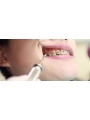 Dental Implant Screw Driver Implant Tools Dentist Intrusment 1Pc/Pack EASYINSMILE
