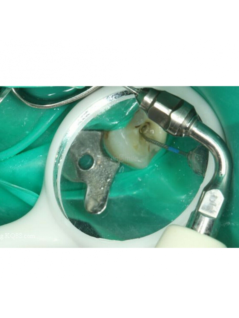 Dental Endodontic Ultrasonic Scaler Tip Files Endo Root Canal Cleaning